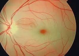 RETINAL ARTERY OCCLUSION