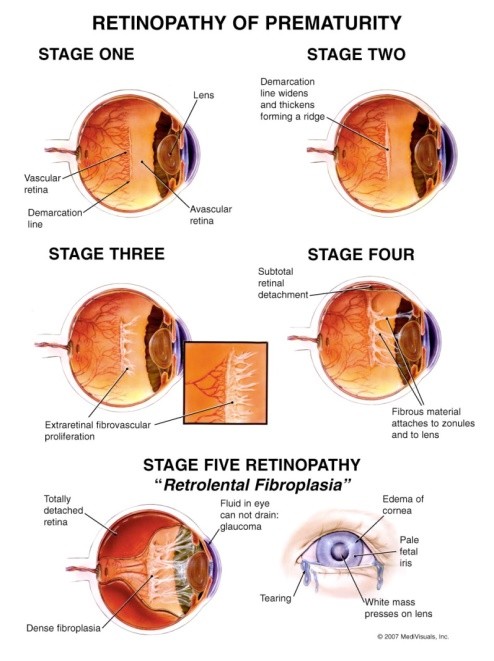 RETINOPATHY OF PREMATURITY