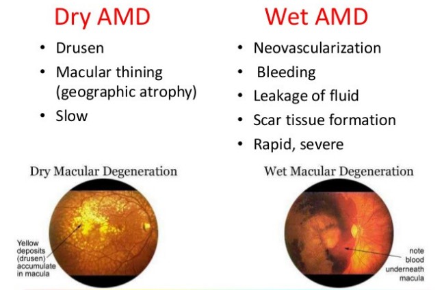 AGE-RELATED MACULAR DEGENERATION