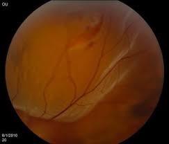 RETINAL DETACHMENT