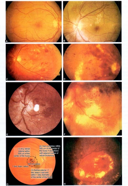 DIABETIC RETINOPATHY