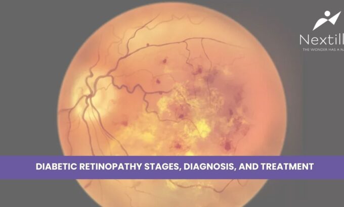 DIABETIC RETINOPATHY STAGES, DIAGNOSIS, AND TREATMENT