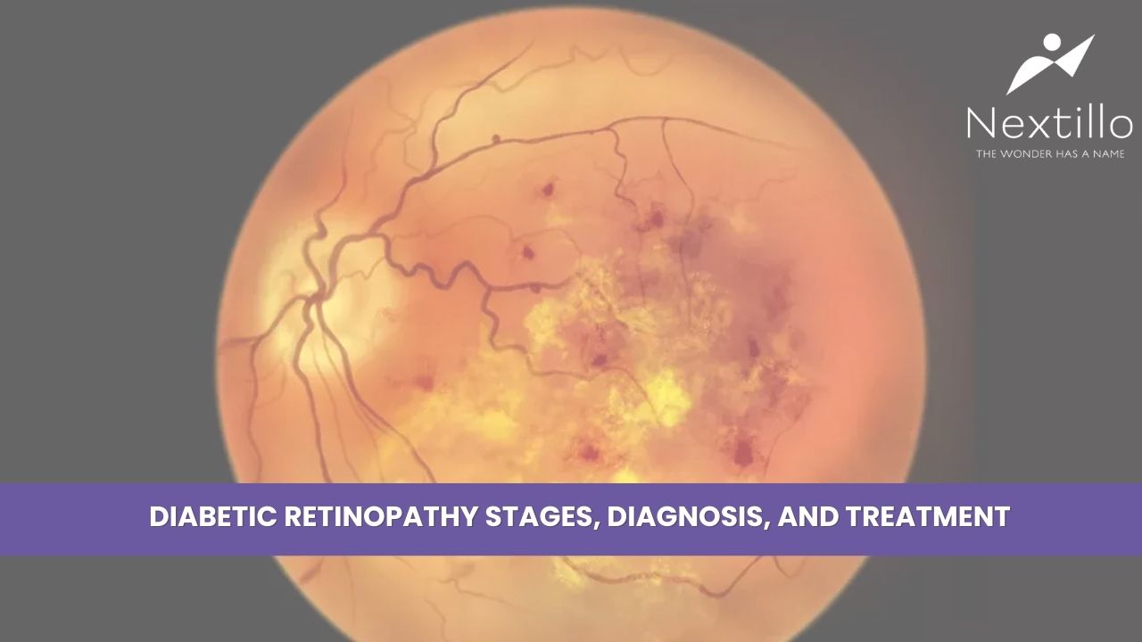 Diabetic Retinopathy Stages, Diagnosis, and Treatment